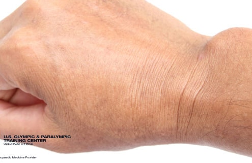 Ganglion Cysts