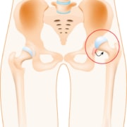 hip dislocation