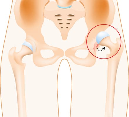 Dislocation of hip - Colorado Center of Orthopaedic Excellence hip dislocation