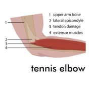 Tennis Elbow