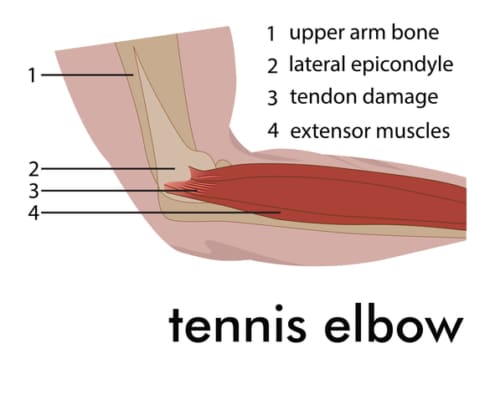 tennis elbow - Colorado Center of Orthopaedic Excellence Tennis Elbow