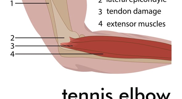 Tennis Elbow
