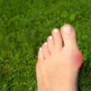 bunion treatment