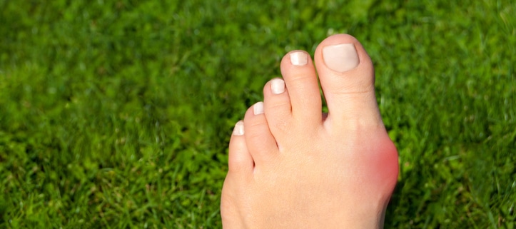 bunion treatment