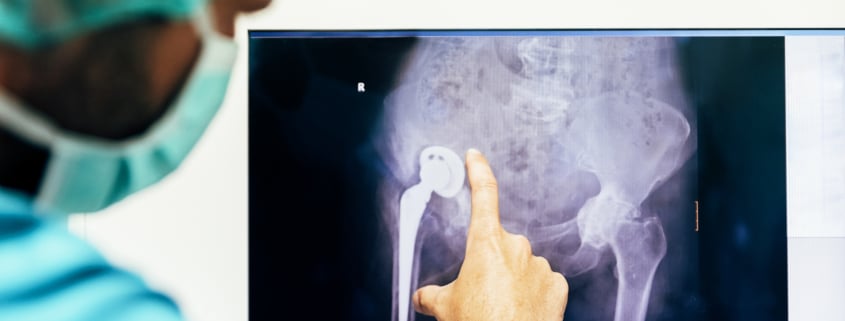 Medicine doctor looking x-ray image. - Colorado Center of Orthopaedic Excellence Orthopedic FAQ