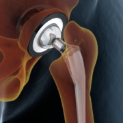 Medically accurate illustration of the hip replacement. 3d illustration. - Colorado Center of Orthopaedic Excellence hip joint replacement