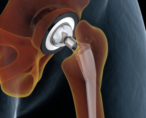 hip joint replacement