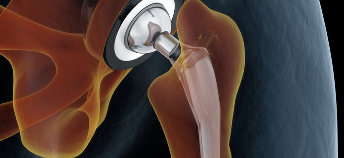 hip joint replacement