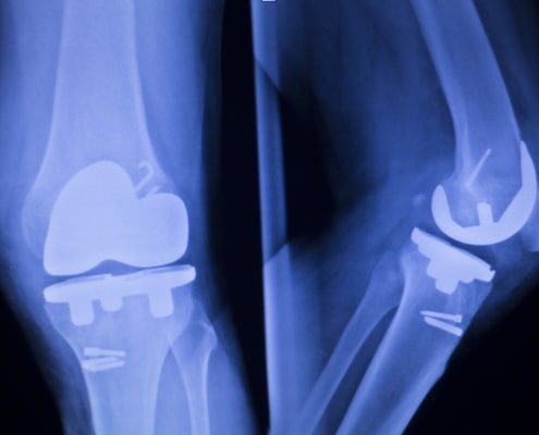 knee replacement