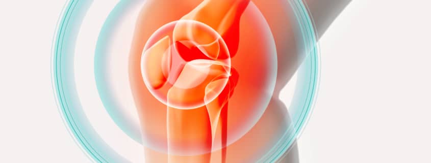 Knee painful - skeleton x-ray.