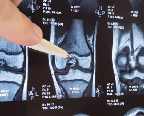 Knee joint x-ray or MRI. Doctor pointed on area of knee joint, where pathology or problem is detected, such fracture, destruction of joint, osteoarthritis. Diagnosis of knee diseases by radiology - Colorado Center of Orthopaedic Excellence knee x-ray