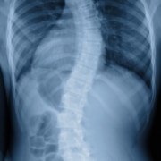 Scoliosis film x-ray show spinal bend in teenager patient