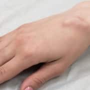 Ganglion Cyst