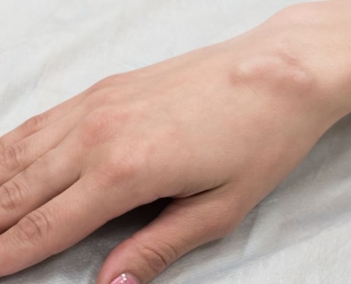 Ganglion Cyst