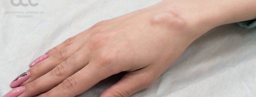 Ganglion Cyst