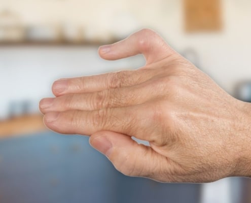 Boutonnière Deformity