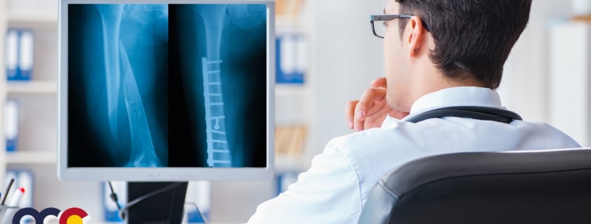 OCC - Colorado Center of Orthopaedic Excellence Femur Fracture