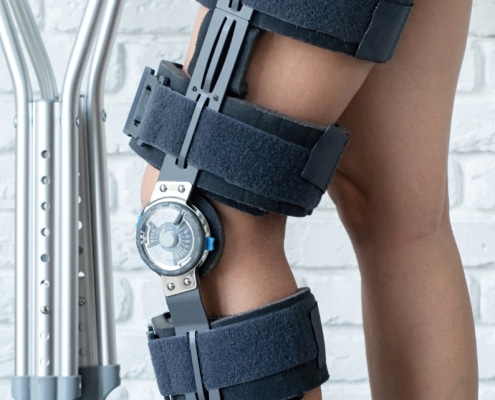 Combined Ligament Injury (Blown Knee)