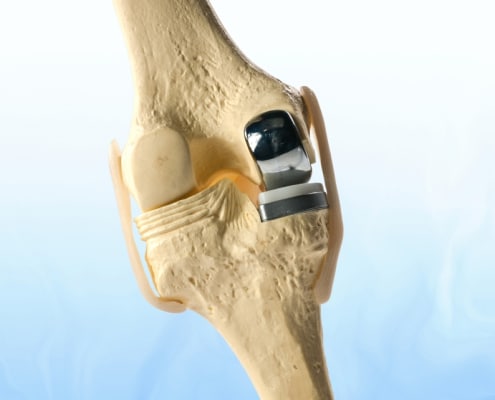 Unicompartmental Knee Replacement