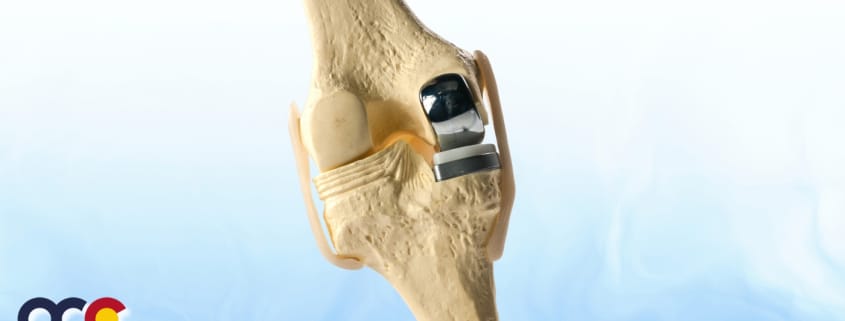 Unicompartmental Knee Replacement